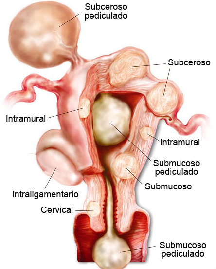 Tipos miomas