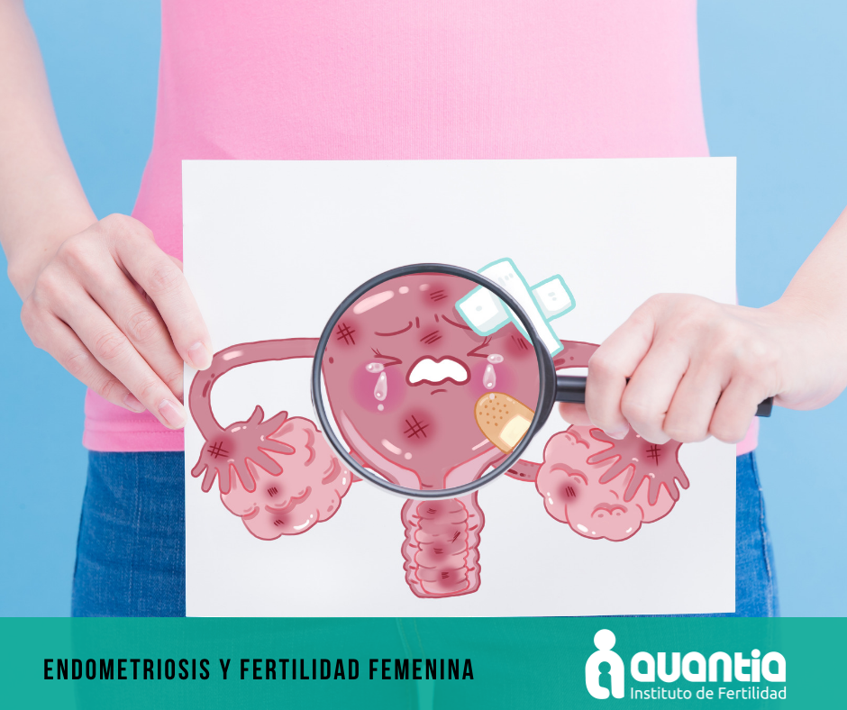 Endometriosis y fertilidad