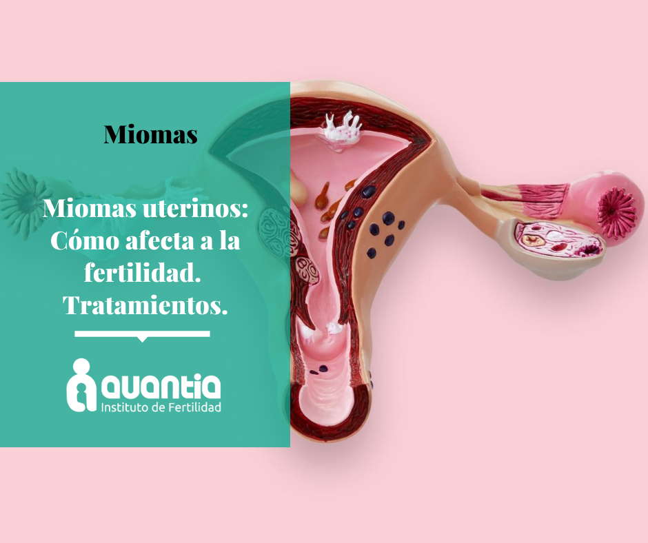 Miomas uterinos y fertilidad